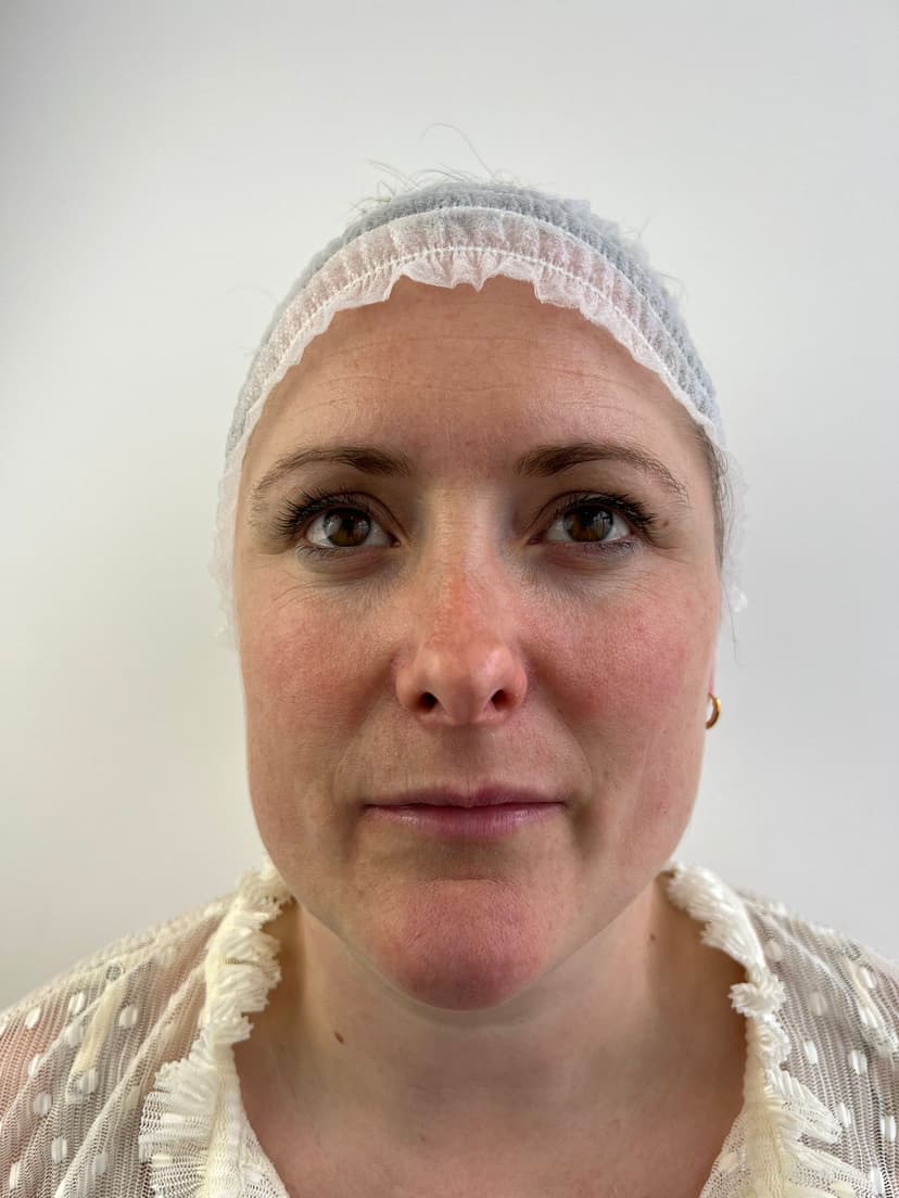 A mid-treatment photo showing Dr. Vongai's expert care.