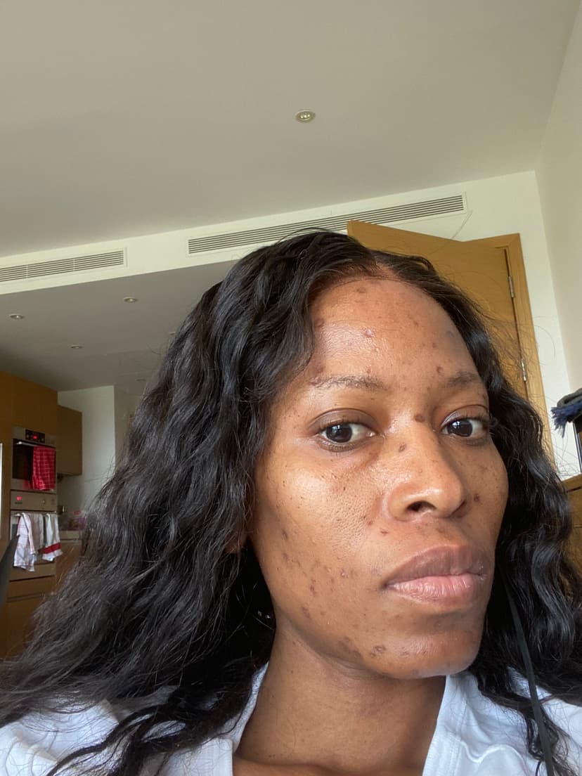 Before photo of a client's skin concern.