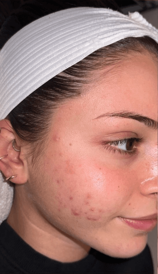 A mid-treatment photo showing Dr. Vongai's expert care.